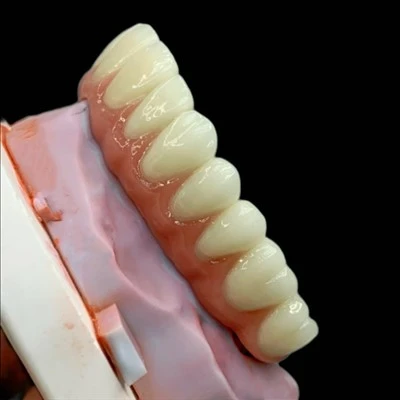 Jembatan CoCr PFM Dengan Porselen Gingiva